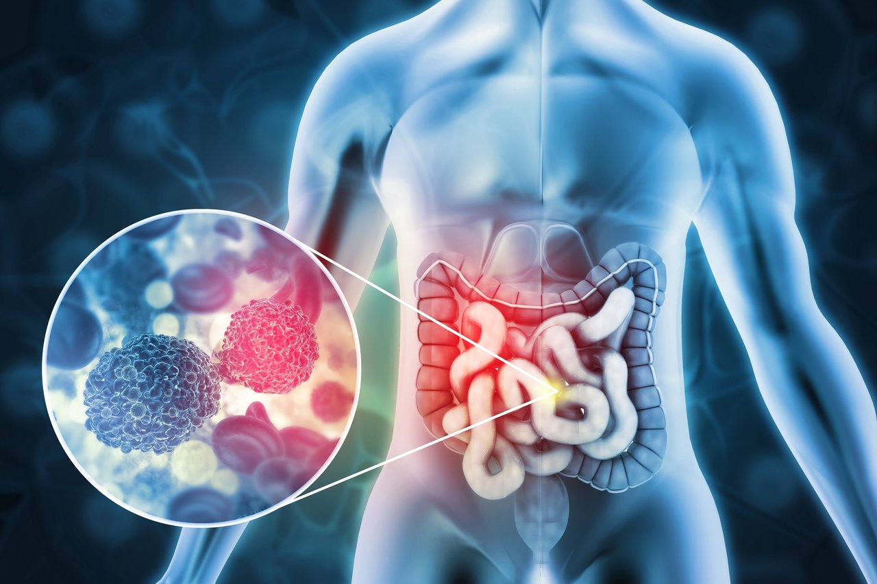 colorectal-cancer-your-questions-answered